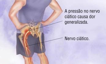 Dor no nervo ciático - Massagem - Centro - São José SC